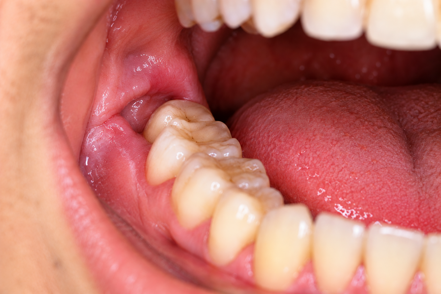 Wisdom teeth extraction — before